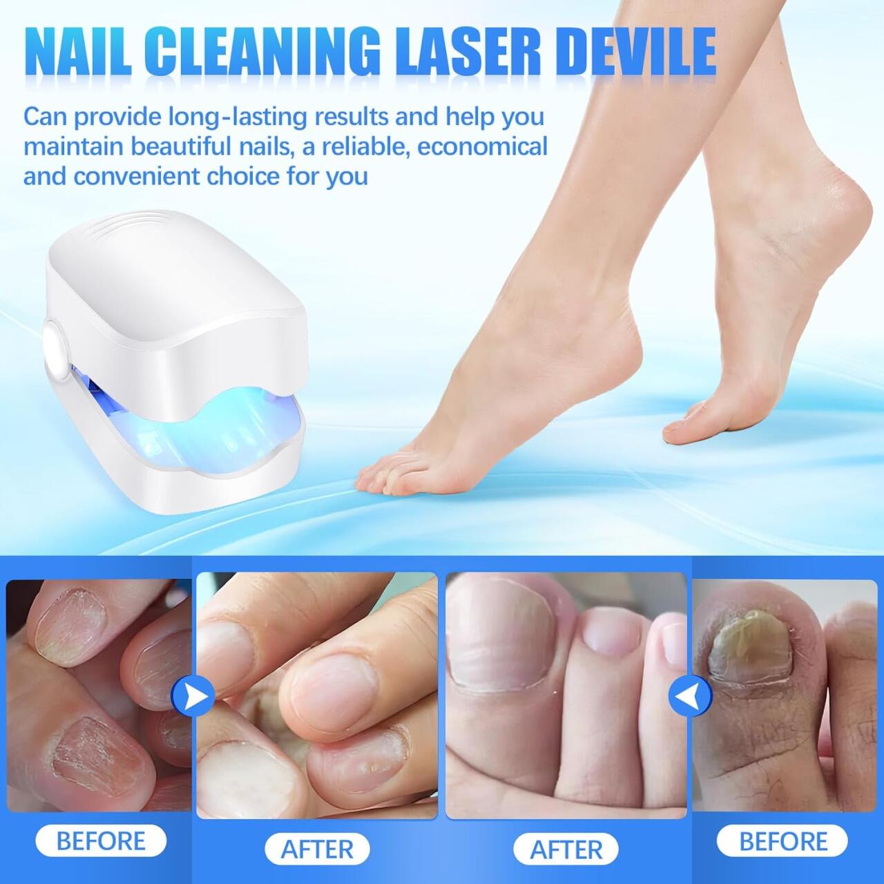 Dispositivo Láser para Tratamiento de Hongos Uñas - innovagizmo.com